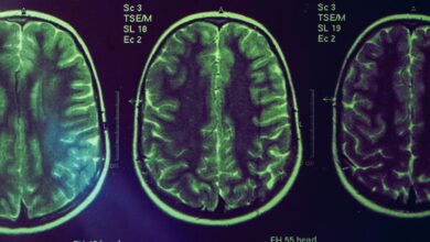 Uma nova droga para Alzheimer encolhe o cérebro. Os cientistas dizem que esse é o ponto. : Alerta Ciência