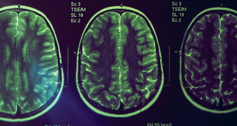 Uma nova droga para Alzheimer encolhe o cérebro. Os cientistas dizem que esse é o ponto. : Alerta Ciência