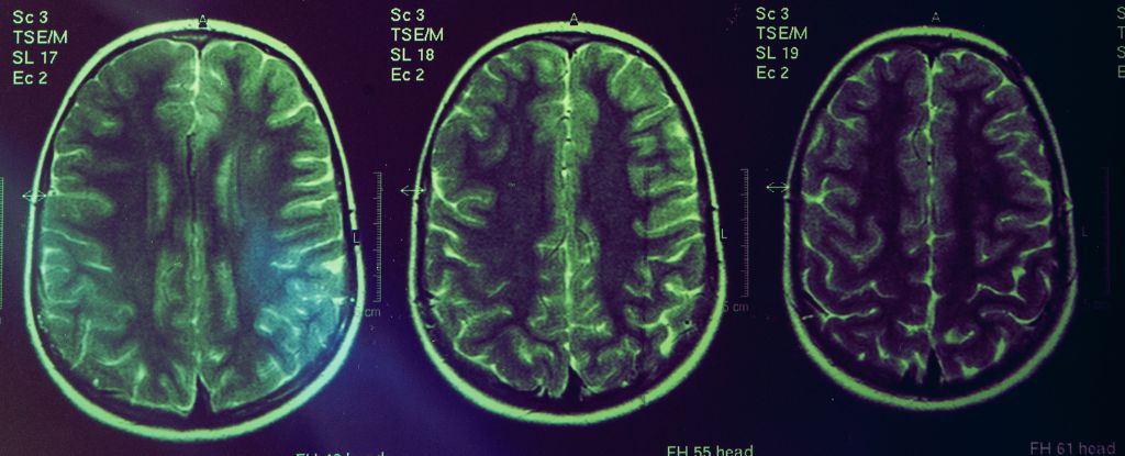 Uma nova droga para Alzheimer encolhe o cérebro. Os cientistas dizem que esse é o ponto. : Alerta Ciência