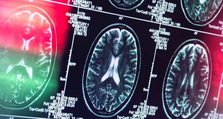 Alzheimer pode não ser realmente uma doença cerebral, revela um especialista: ScienceAlert