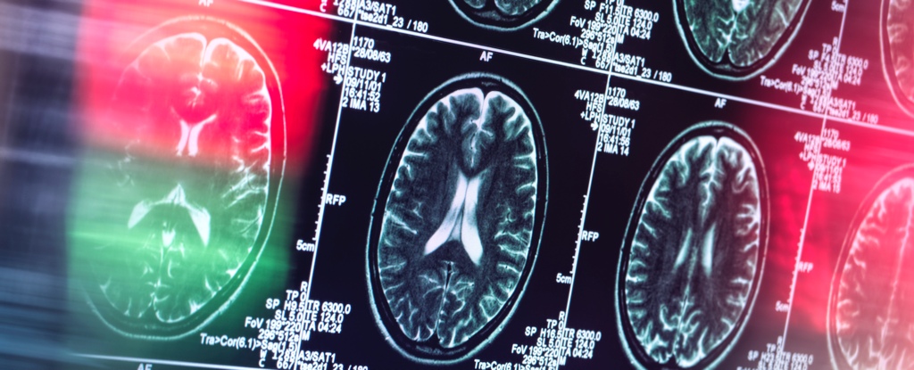 Alzheimer pode não ser realmente uma doença cerebral, revela um especialista: ScienceAlert