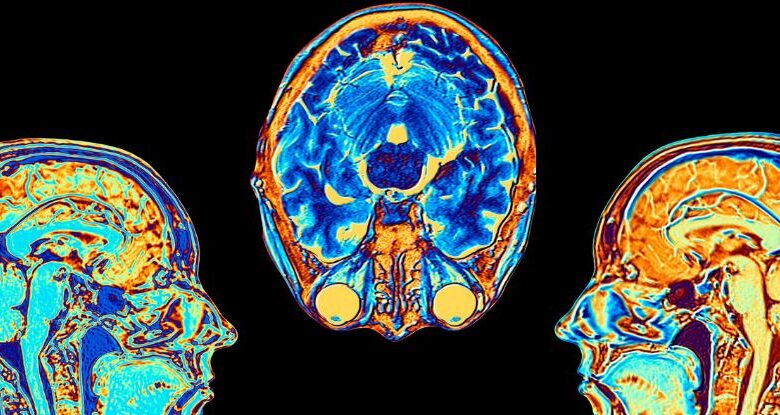 Diabetes tipo 2 está associado ao encolhimento acelerado do cérebro, revela estudo: ScienceAlert