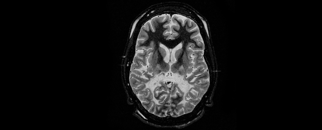 Tratamento promissor para doenças cerebrais devastadoras que podem causar câncer: ScienceAlert