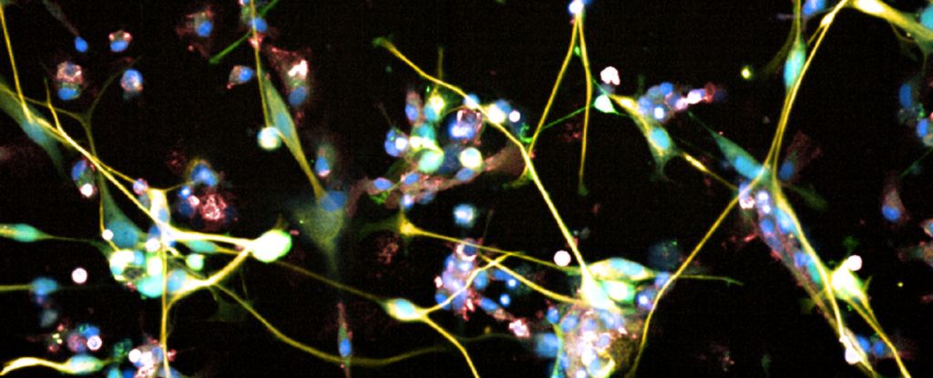 Antidepressivo aprovado pela FDA trata câncer cerebral incurável em ensaio pré-clínico: ScienceAlert