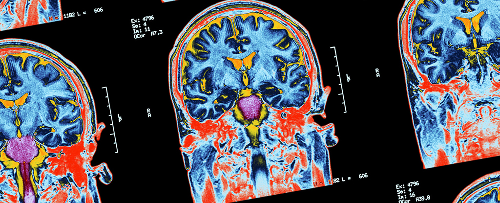 Consciência oculta detectada em 25% dos pacientes que não respondem testados: ScienceAlert