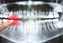 Especialista alerta por que você nunca deve se tornar seu próprio dentista: ScienceAlert