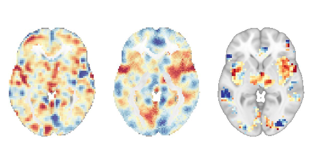 três varreduras cerebrais mostrando as diferentes assinaturas neurais associadas à resposta à dor. da esquerda para a direita estão o NAPS, o SIIPS-1 e o NPS.