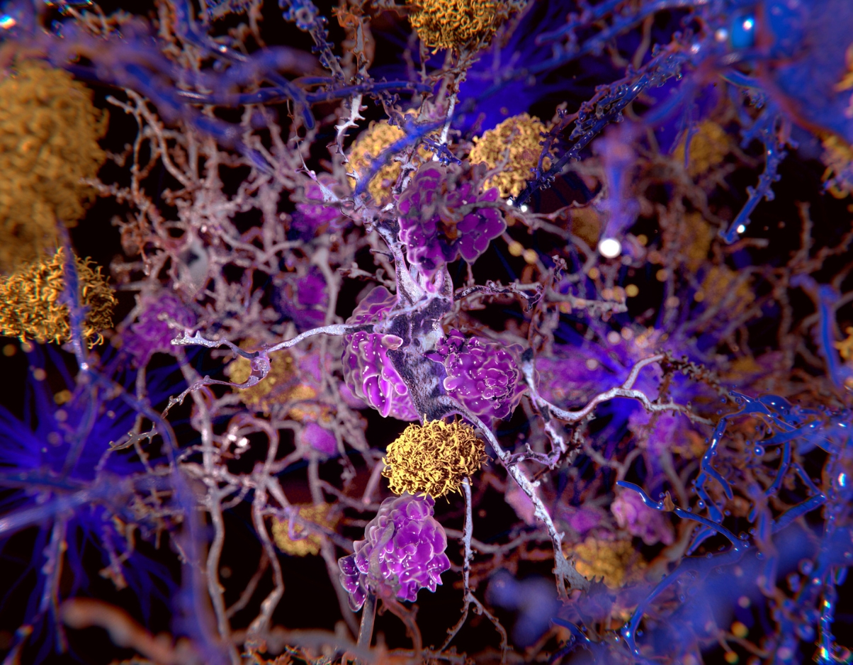 Aglomerados amarelos se formando entre neurônios roxos