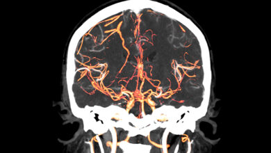 O ponto de partida da esquizofrenia pode ter sido encontrado em exames cerebrais: Sciencealert