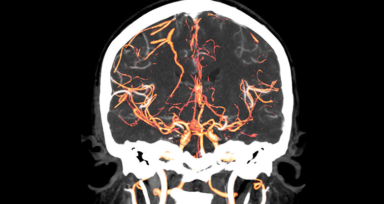 O ponto de partida da esquizofrenia pode ter sido encontrado em exames cerebrais: Sciencealert