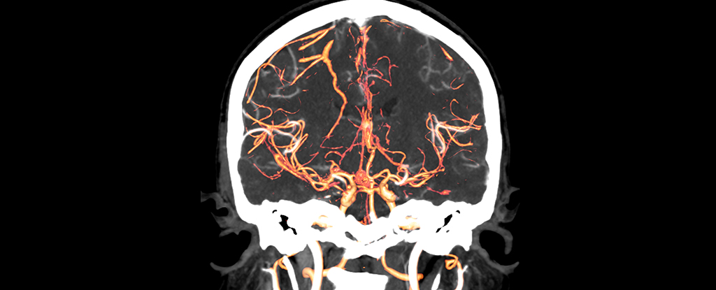 O ponto de partida da esquizofrenia pode ter sido encontrado em exames cerebrais: Sciencealert