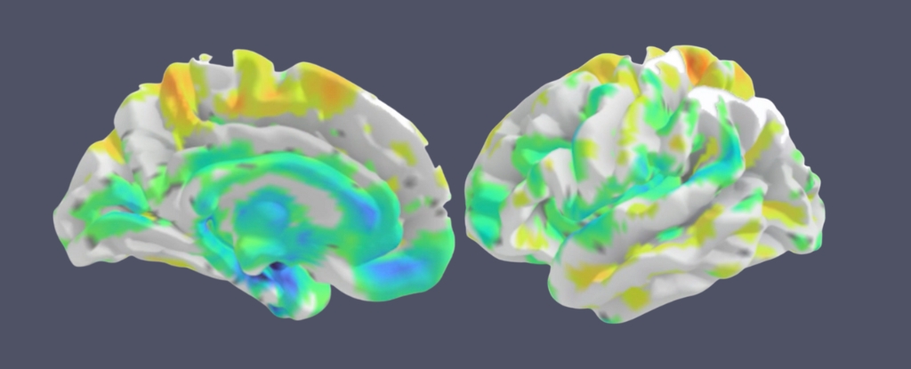 Os cientistas nomeiam o novo tipo de perda de memória frequentemente confundida com Alzheimer: Sciencealert