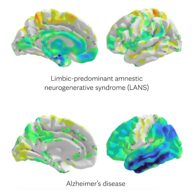 Conjuntos de varreduras cerebrais mostrando diferentes regiões coloridas