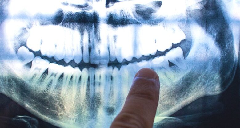 Prevê-se que a maior parte do Reino Unido terá doenças dentárias até 2050, conclui estudo: ScienceAlert