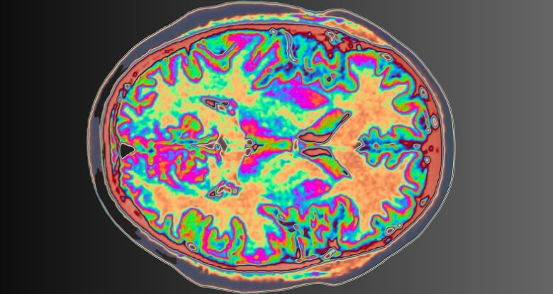 A FDA aprova a nova droga de Alzheimer para os primeiros sintomas de doenças: Sciencealert