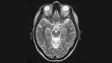 Novo teste prevê o futuro declínio cognitivo na doença de Alzheimer: Sciencealert