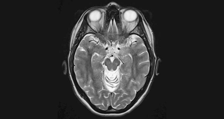 Novo teste prevê o futuro declínio cognitivo na doença de Alzheimer: Sciencealert