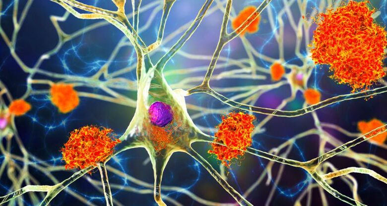 O spray nasal do novo Alzheimer limpa emaranhados tóxicos em neurônios e ratos humanos: Sciencealert