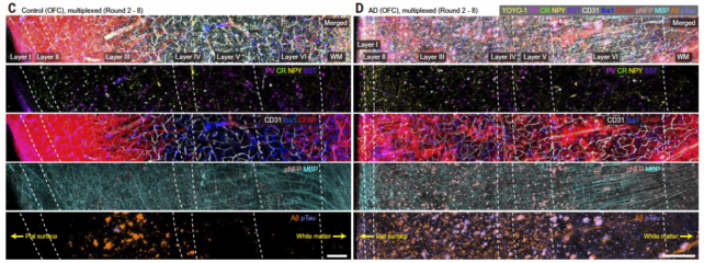 Painel de imagens mostrando camadas de células cerebrais na doença de Alzheimer e um controle saudável.
