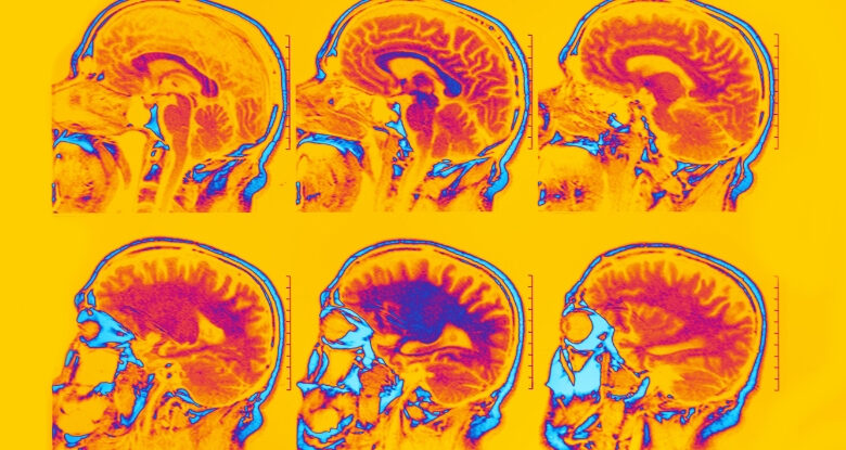 As varreduras cerebrais identificam seis tipos distintos de depressão e ansiedade: Sciencealert