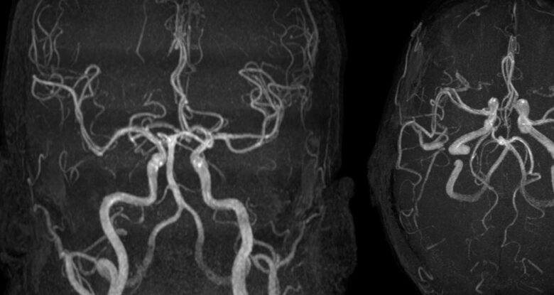 Fumando fentanil ligado a danos cerebrais tóxicos no primeiro caso relatado: Sciencealert